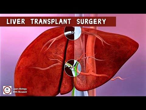 Liver Transplant surgery | Animation Video