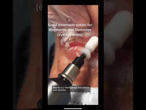 BlephEx, blepharitis (eyelid inflammation) and demodox (eyelash mites) treatment.