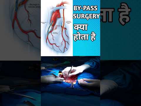 By pass surgery for heart| Credit-@rajshamani #bypasssurgery #heart