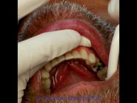 Fixed (bonded) lower retainer insertion