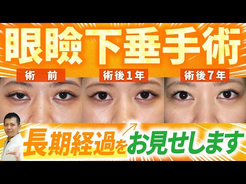 【長期経過】眼瞼下垂手術の術後7年の患者様の状態を紹介します！