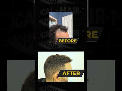 ⚡️FUE Hair Transplant Results / #hairtransplantresults #hairtransplantbeforeandafter