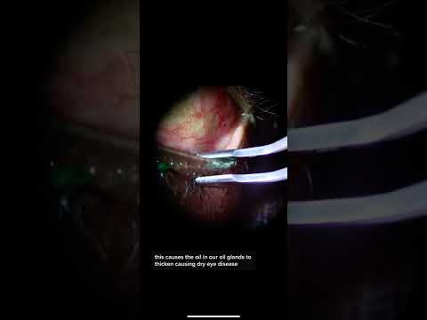 Electronic devices and dry eye