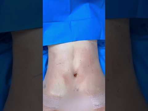 Results of a Drainless Body Lift + BBL by Dr.Bucio #cosmeticsurgery #certified