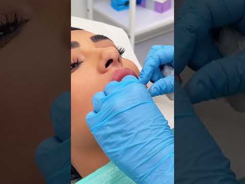 Lip filler injection to hydrate and shape lips. #torontofiller #torontolife  #cosmeticsblogger