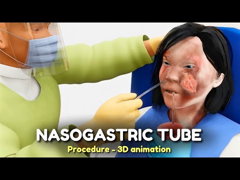 Nasogastric (NG) Tube Procedure | 3D animation