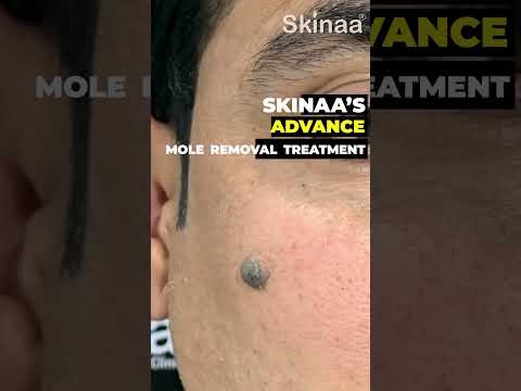 Best Mole Removal Treatment at Skinaa Clinic| Viral #shortsviral