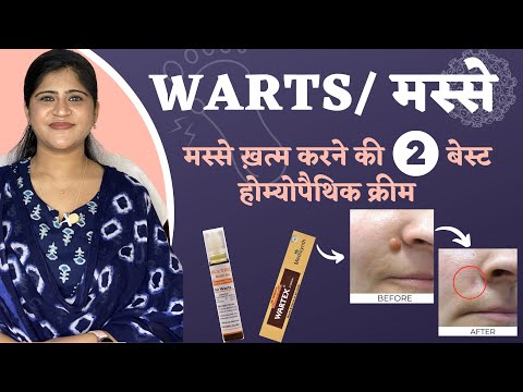 Warts/ मस्से : ख़त्म करने की 2 बेस्ट होम्योपैथिक क्रीम | Warts Homeopathic Treatment |Dr. Arwa Bohra