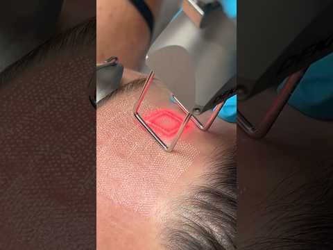 Co2 Resurfacing with #co2 #laser #resurfacing #trending #shorts #reels #viral