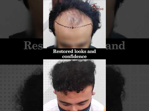 Aneesh’s 9-Month Hair Transformation | From Bald to Bold with Hair Transplant!