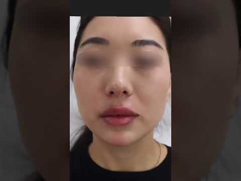 Filler Migration correction using dissolve and re-injection of filler into the lips and chin!💉