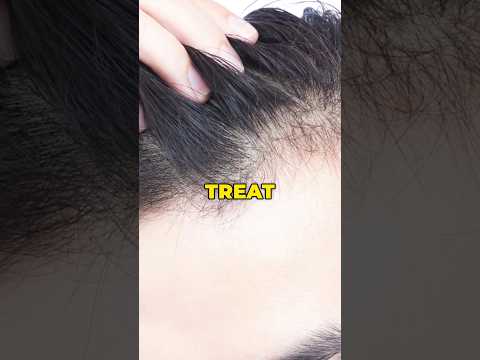 Treatment or Surgery for Hair Density ? #drranairfan #hairdensity  #hairtransplant #fyp #shorts