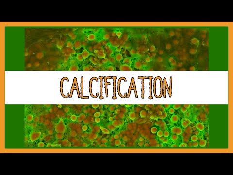 Dystrophic vs. Metastatic Calcification