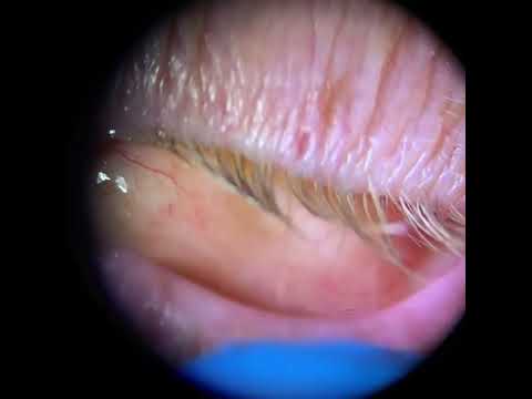 Prosthetic Eye