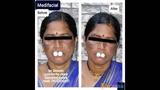 #face #cosmetic #skin #skincare #detanfacial #detan #detanning #medifacial #galvanicafacial