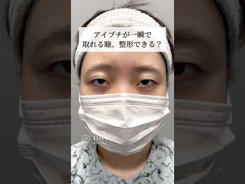 [Double eyelid surgery] What happens to heavy eyelids after surgery? #shorts