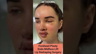 INCREDIBLE FFS FACIAL FEMINIZATION SURGERY RESULTS - 10 DAYS OUT !!