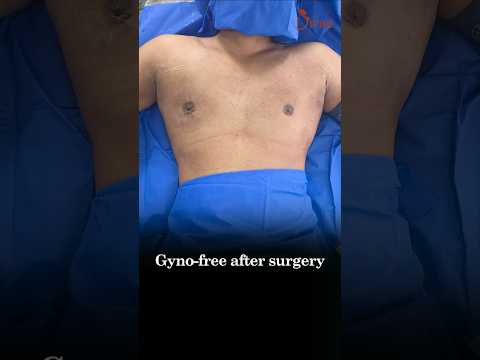 Asymmetrical Gynecomastia Surgery On Table Result | Male Breast Reduction