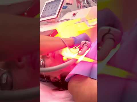 Broadband Light, forever young treatment for glowing youthful skin. #torontobroadbandlight #avebelle