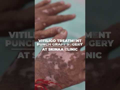 Effective Vitiligo (White Patches) Treatment at Skinaa Clinic #viralshorts #vitiligotreatment