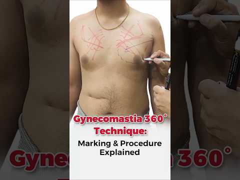 Gynecomastia 360° Technique: Marking & Procedure Explained #ytshort