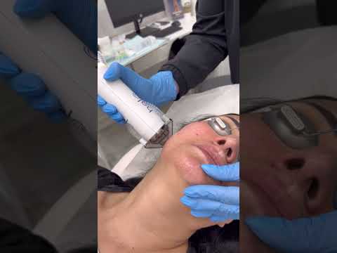 Halo, laser resurfacing ⚡️⚡️⚡️ #torontoskin #torontoblogger #torontolife #halo