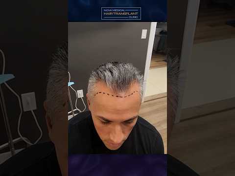 🚀Instant Witness: FUE Results Post-Op / #hairtransplantfue #hairsurgery #hairgrowth