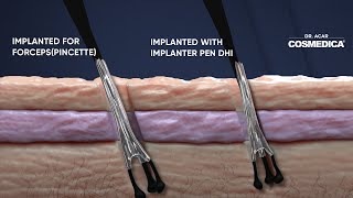 Dhi Micro Sapphire vs Fue Cosmedica Hair Transplant Dr. Acar