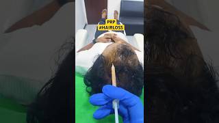 Hair Loss Treatment #hair #hairloss #hairlosstreatment #ytshorts #alopecia #hairtransplant #hairfall