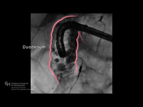 Lymphatic Embolization