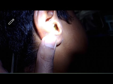 Overflowing Ear wax Removed /Ear Wax Removal ASMR / #earwax #satisfying