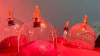 Ayo Bekam di Rumah bekam Hijamah care situbondo