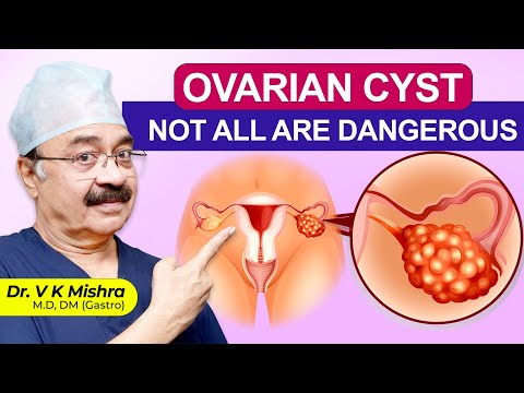 ARE OVARIAN CYSTS CANCERS || Ovarian Cyst hindi #ovariancysts