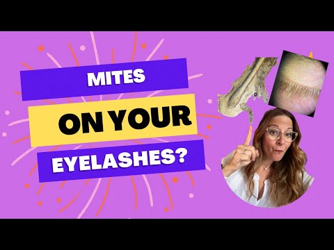Eyelash Mites or Demodex