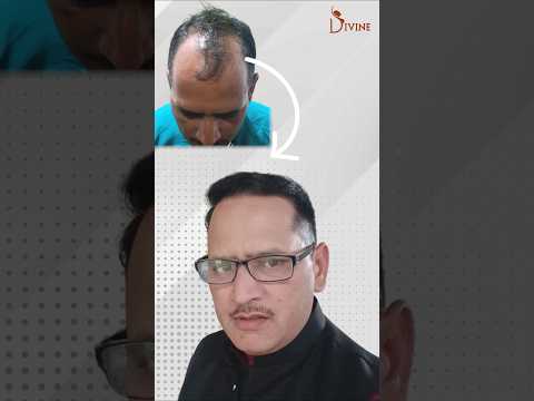 From Bald to Bold: Stunning Hair Transplant Transformation in 7 Months!