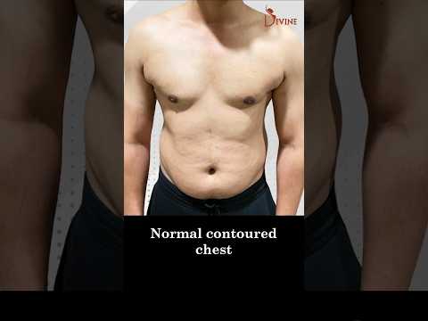 Grade 3A Gynecomastia: Before and After 3 Months Result | Male Breast Treatment #shortsfeed