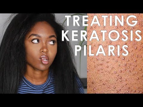 TREATING KERATOSIS PILARIS - 3 EASY STEPS
