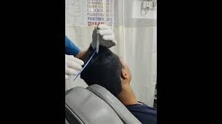 Scalp Peel Treatment For Dandruff | #shorts #dandruffcontrol #shortsfeed