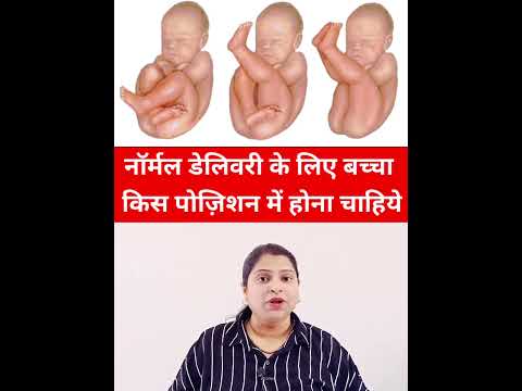 नॉर्मल डेलिवरी के लिए बच्चा किस पोज़िशन में होना चाहिये #shortsvideo