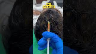 Hair Loss Treatment #hair #hairloss #hairlosstreatment #ytshorts #alopecia #hairtransplant #hairfall