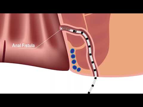 Fistula-Tract Laser Closure FILAC - IBI Healthcare Institute