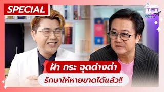 ฝ้า กระ จุดด่างดำ รักษาให้หายขาดได้แล้ว!! | ตีสิบเดย์ HIGHLIGHT Online Special