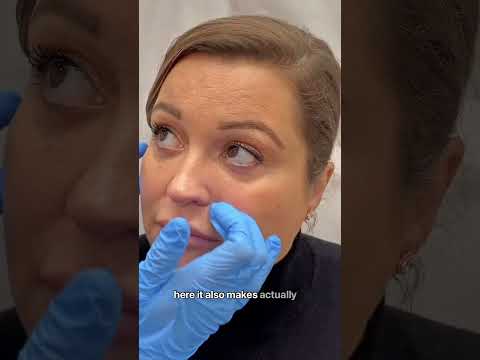 #undereyecorrection #torontocosmetics #avebelle