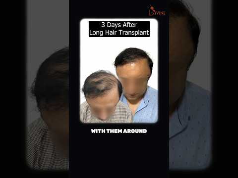 4500 Hair Follicles, 5 Hours, No Shaving! The Ultimate Long Hair Transplant Result