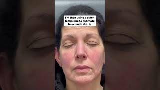 Upper Blepharoplasty - Pre-Surgery Markings