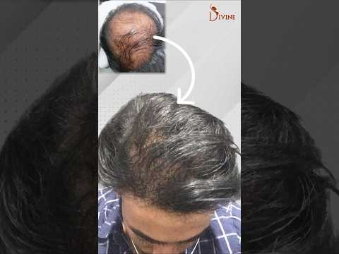 Synthetic Hair Transplant Before and After | Synthetic (Biofiber) Hair Transplant in Delhi