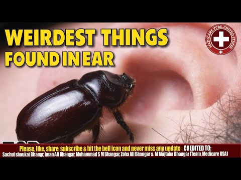 Weirdest Things Found in Ears! (Safe & Shocking Discoveries 🤯)