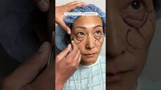 3 Weeks After Upper & Lower Blepharoplasty with Dr. Kami Parsa | Quadfecta Lift