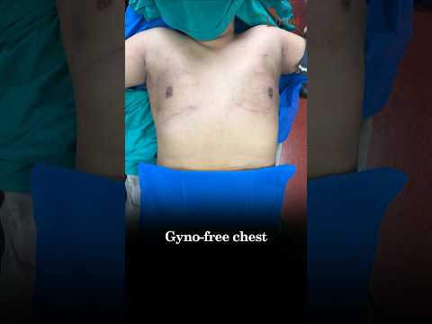 Gynecomastia Gone in 30 Minutes! Scarless 360° 4DX Chest Transformation