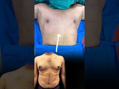 Gynecomastia Result Just After Surgery | Gynecomastia Surgery in Delhi #shorts